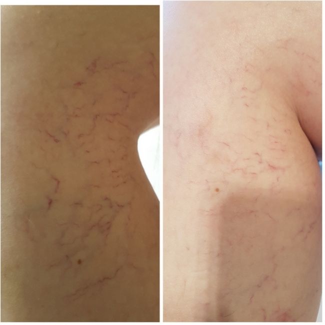 Laserowe zamykanie naczynek Kraków przed i po efekty